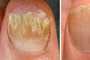 Основные причины болезней ногтей на руках, их лечение и профилактические меры